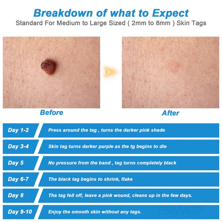 2 IN 1 Auto Skin Tag Remover Kit Micro Skin Tag Removal Device